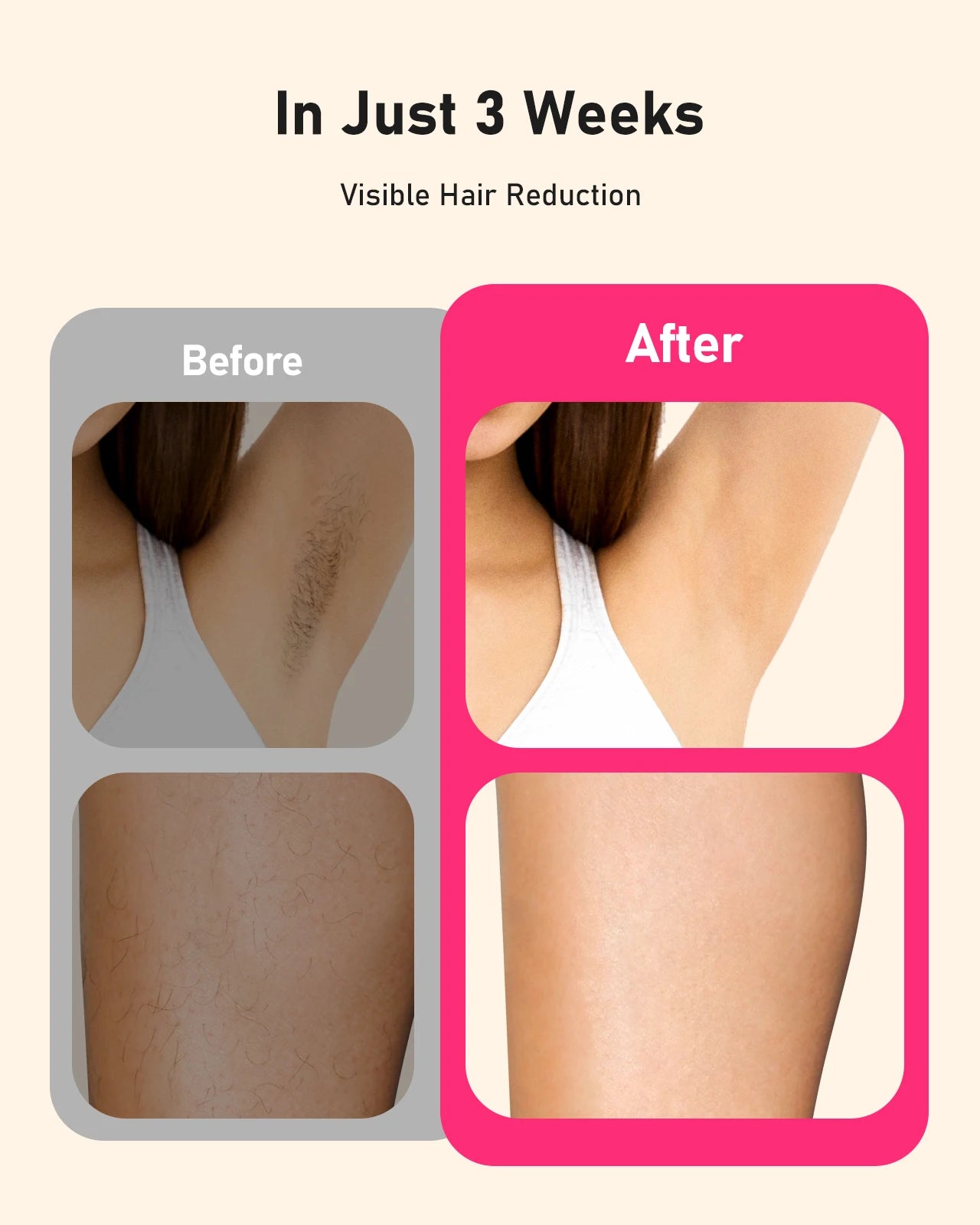 AI06 IPL Hair Removal Device | 999,999 Flashes, 9 Energy Levels, Auto & Manual Modes | Painless Long-Term Laser Hair Removal at Home